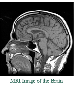 example of a brain MRI image