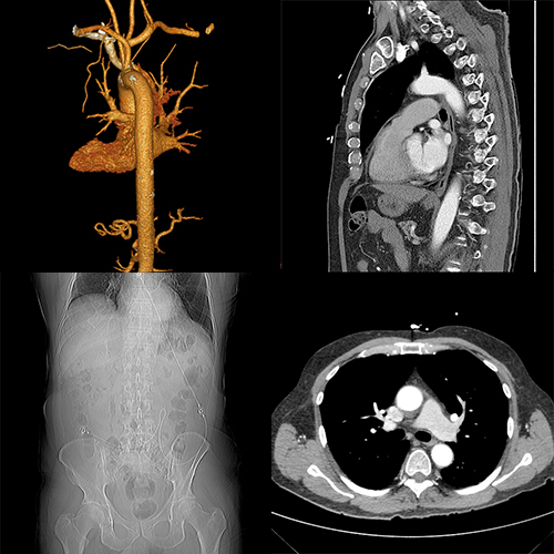 CT images of the chest
