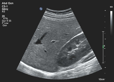 Ultrasound image of the liver