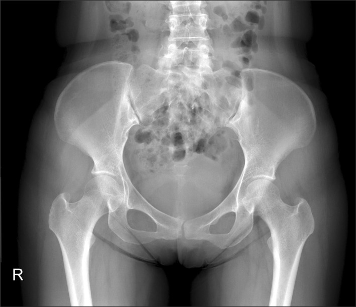 X-ray image of the pelvis